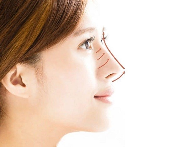 Nâng mũi sụn sườn Topnose có đáng để thực hiện hay không?